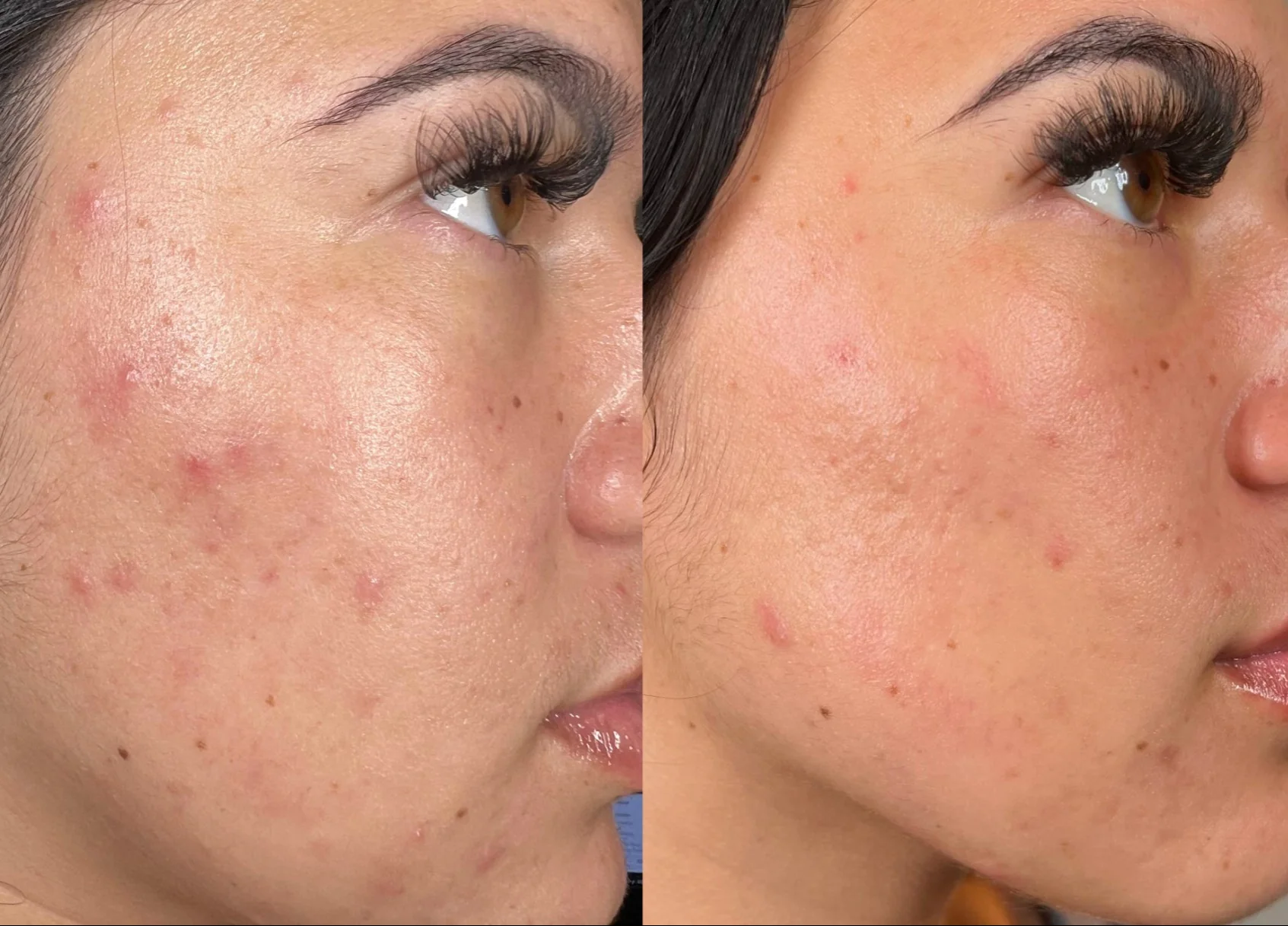 Before_After_Desktop_Acne