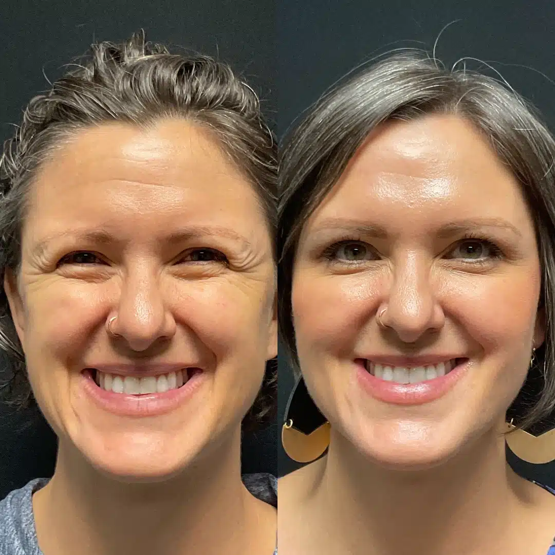 Jessica_Botox_VolumaCheeks_VolbellaIOH_UltraLips_Part2_Facette