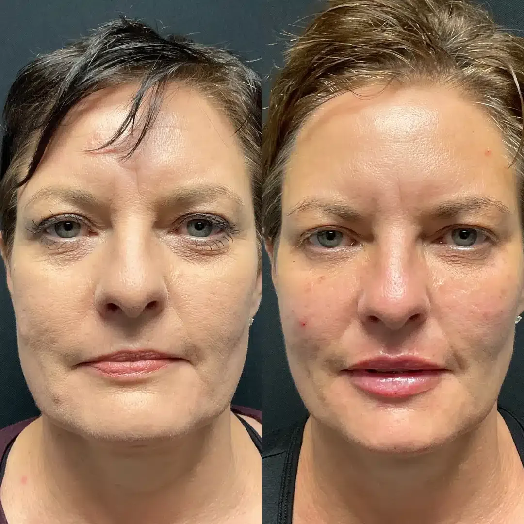 imgi_12_Jessica_Botox_VolumaCheeks_VolbellaIOH_UltraLips_Part1_Facette