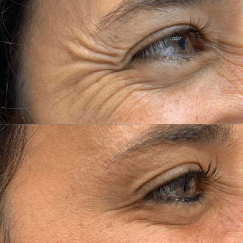 onlypeptide-blog-snap-8-peptide-for-wrinkles